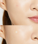 cosrx acne pimple master patch